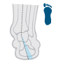 Mild Overpronation