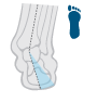 Overpronation